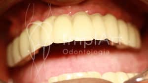 protese fixa de todos os dentes sem gengiva