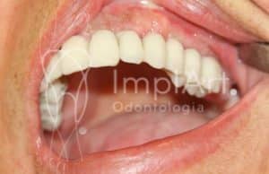 protese metaloceramica sem completa