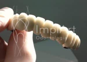 protese metaloceramica sem gengiva
