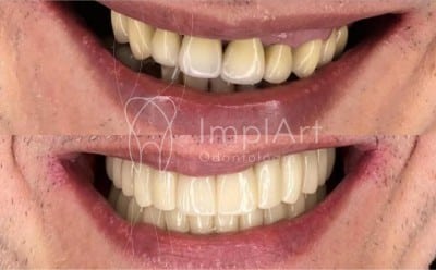 reabilitacao oral com implantes