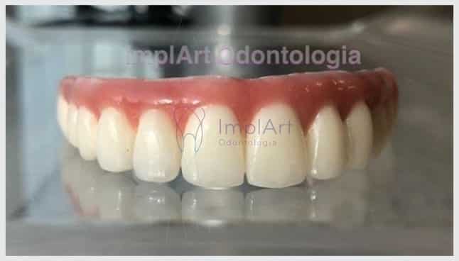 protese de zirconia fixa em implantes dentarios