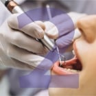 como é feito um implante dentário 23