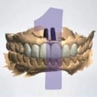 como é feito um implante dentário 21