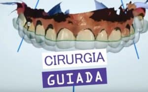 como é feito um implante dentário 60