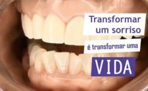 como é feito um implante dentário 64