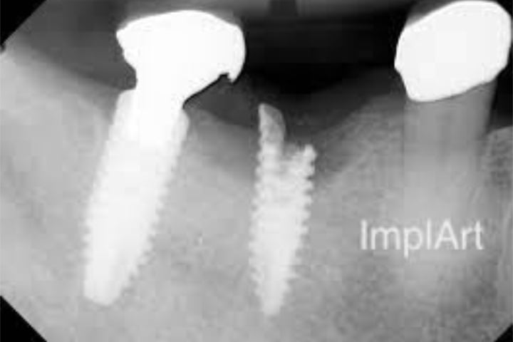 Implante dentario quebrado 50kb