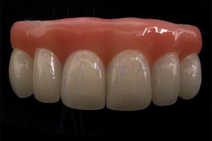 coroa zirconia individual 48kb