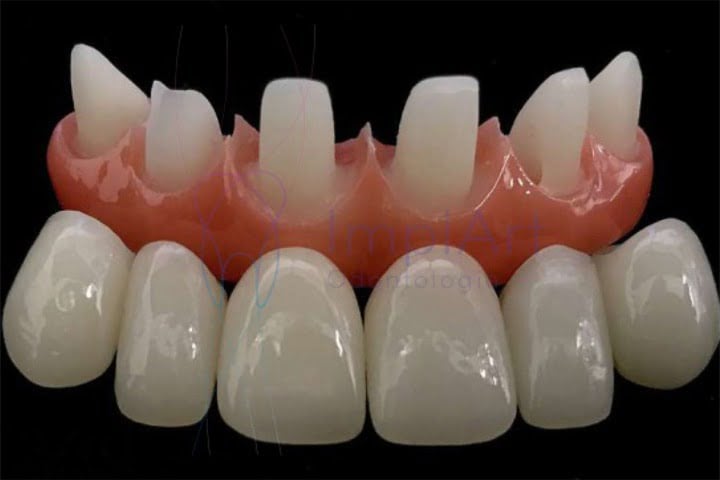 coroa zirconia individual 49kb