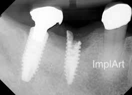 implante dentario quebrado