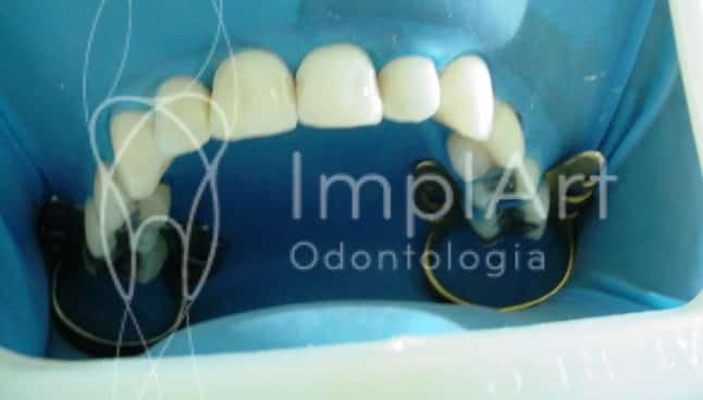 clareamento dental a laser depois