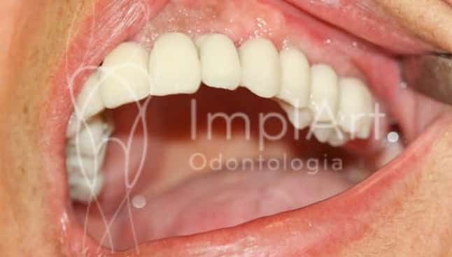 protese metaloceramica sem gengiva arcada completa 50kb