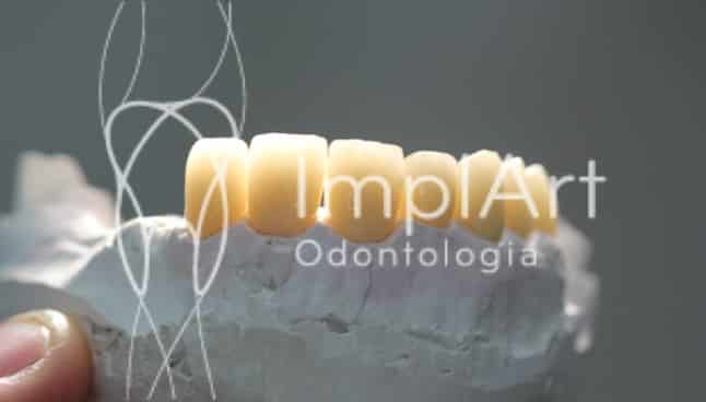 reabilitacao oral com dentes de porcelana 50kb 1