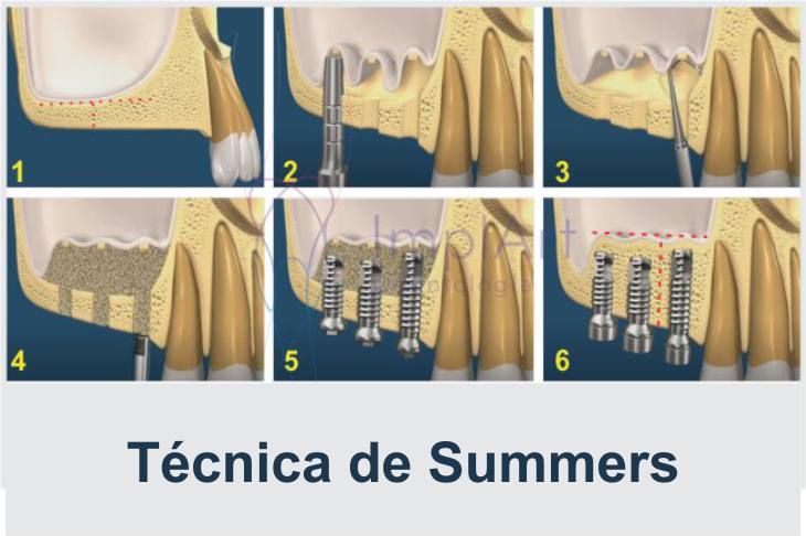 Técnica de Summers