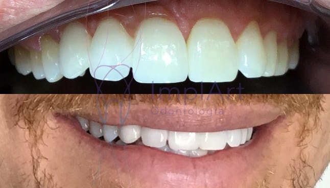 coroa de porcelana fixa sobre implante dentário clareamento dentário