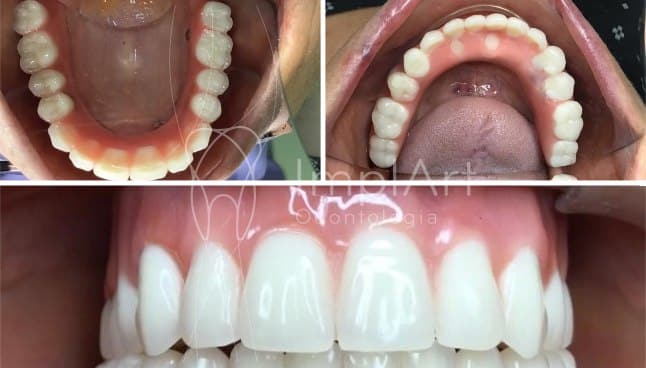 Prótese protocolo dentário aspecto intraoral e palato livre 