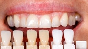 clareamento dental cor