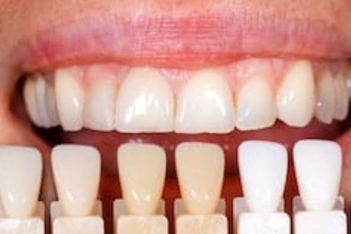 escala cor dentes 50kb