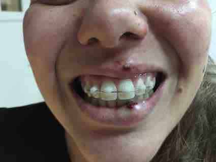 perda de dente acidente