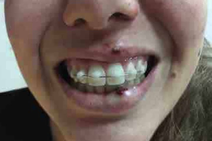 Os implantes dentários podem ser feitos em crianças? 3 perda de dente acidente