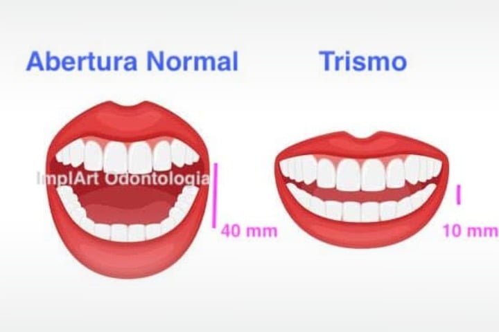 abertura boca normal boca travada trismo 50kb