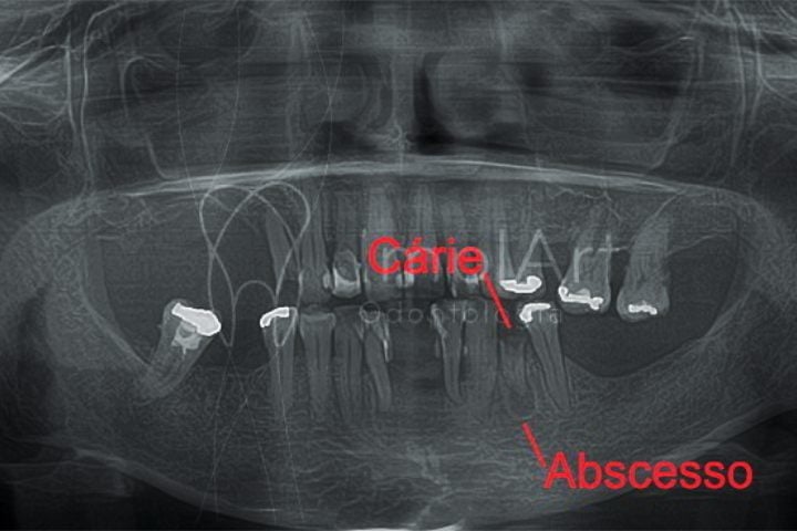 carie e abscesso radiografia 50kb