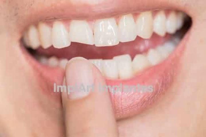 dente quebrado o que fazer 50kb