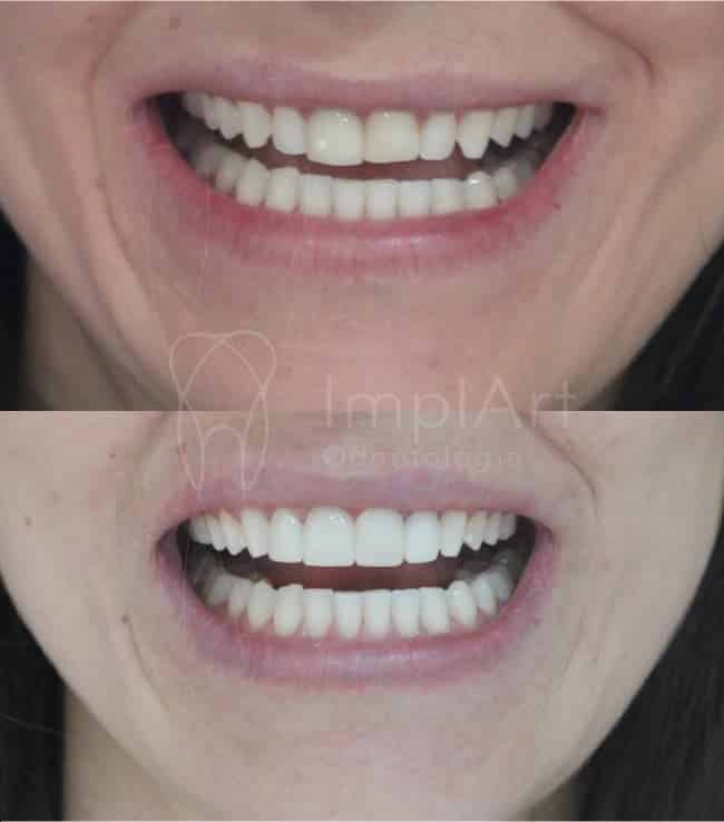 fotos de antes e depois de lentes nos dentes