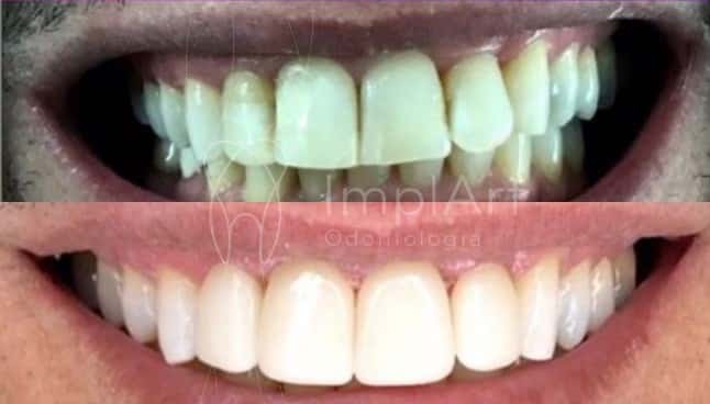 lente contato dental antes e depois 44kb