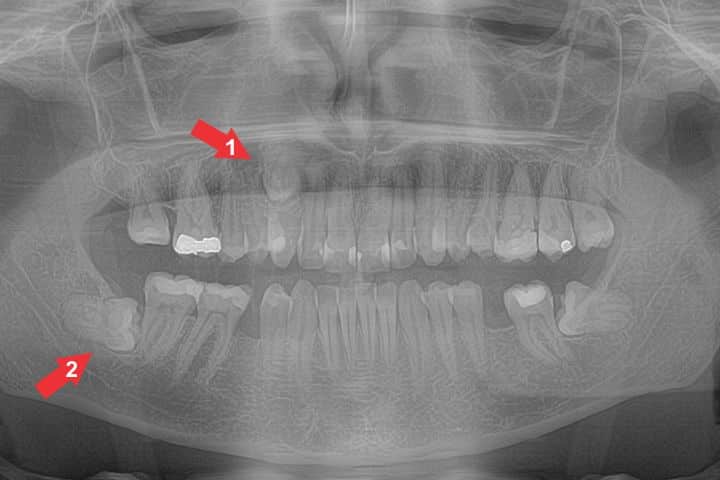 radiografia com dentes impactados