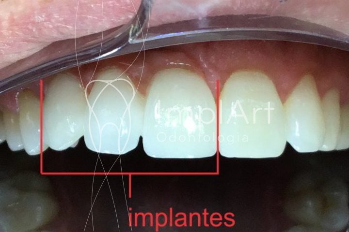 implantes zirconia 49kb