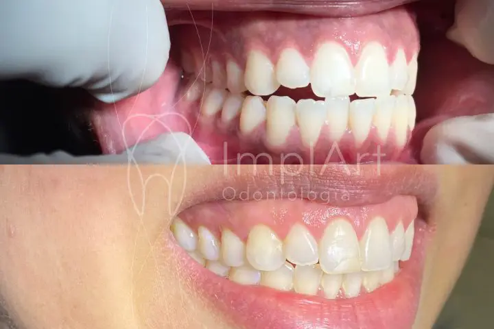 antes e depois do clareamento dental e antes e depois do tratamento com invisalign