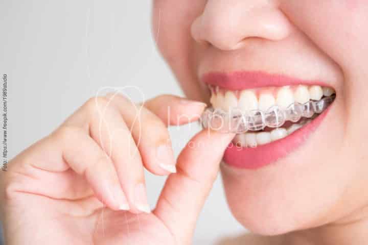 alinhador transparente invisalign alinhador transparente