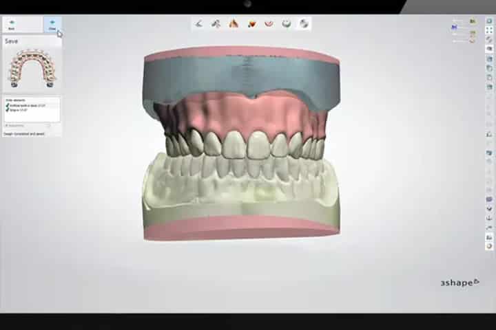 planejamento digital de prótese dentária total