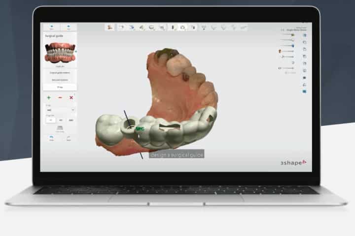 Planejamento computadorizado para a cirurgia guiada de implantes dentarios