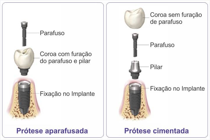 coroa parafusada x coroa cimentada