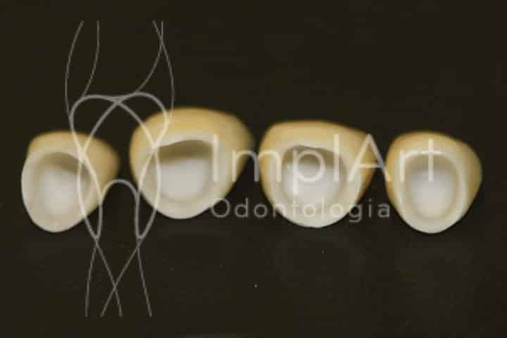 coroa cimentada 50kb