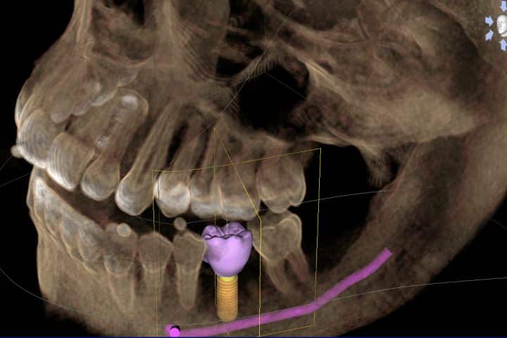 tomografia planejamento de implantes dentarios