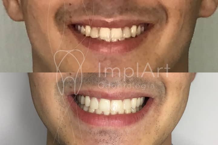 fotos de antes e depois de colocar lentes de contato dentais e clareamento