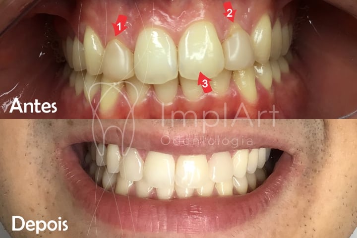 lente dental clareamento antes depois