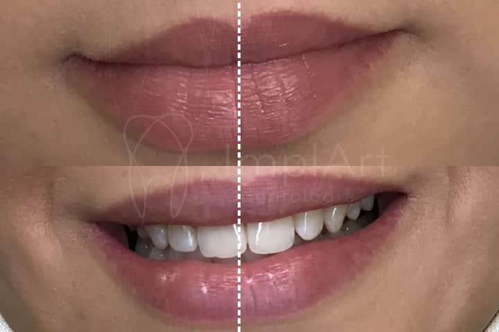 assimetria do sorriso assimetria labial