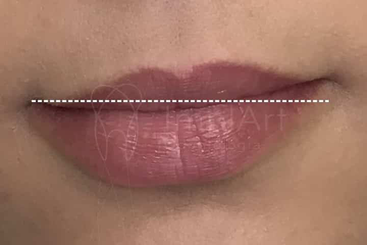 assimetria labial