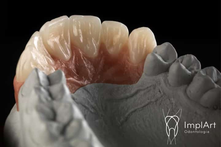 coroa de zirconia implante FX 45kb 1