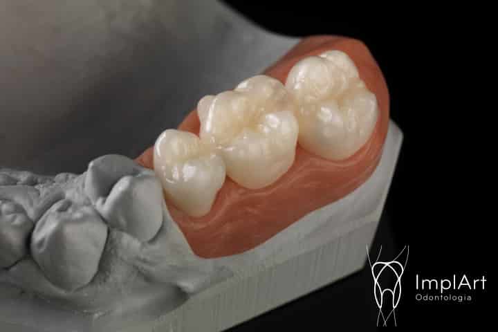 coroa de zirconia implante FX 47kb