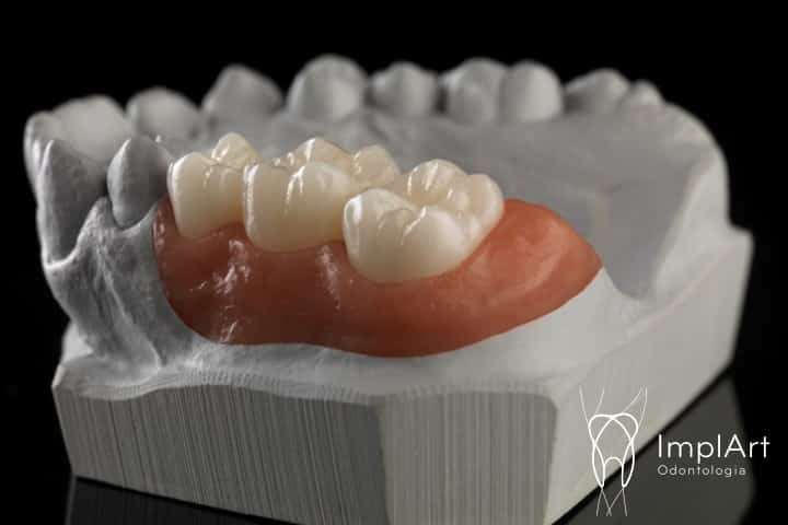 coroa de zirconia implante FX 48kb