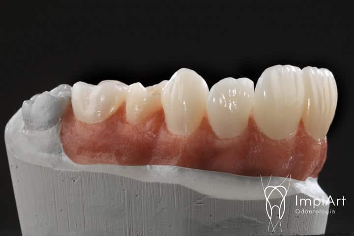 coroa de zirconia implante FX 49kb