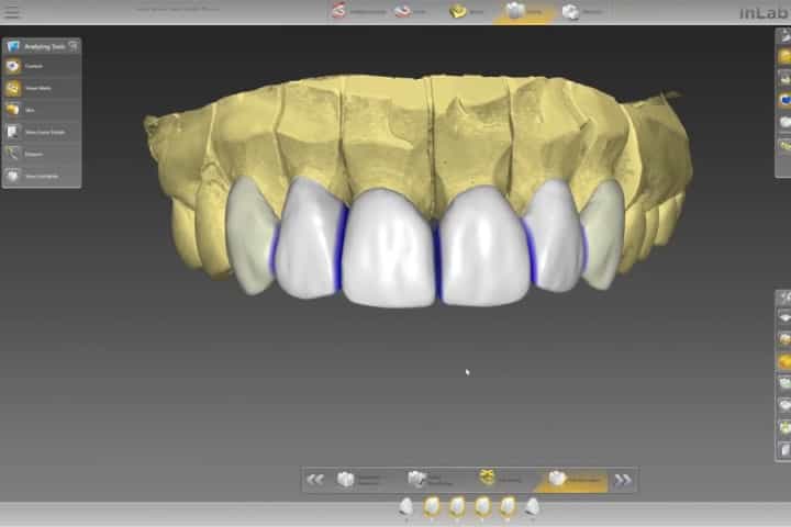 projeto computadorizado de coroas dentarias para repor dentes da frente