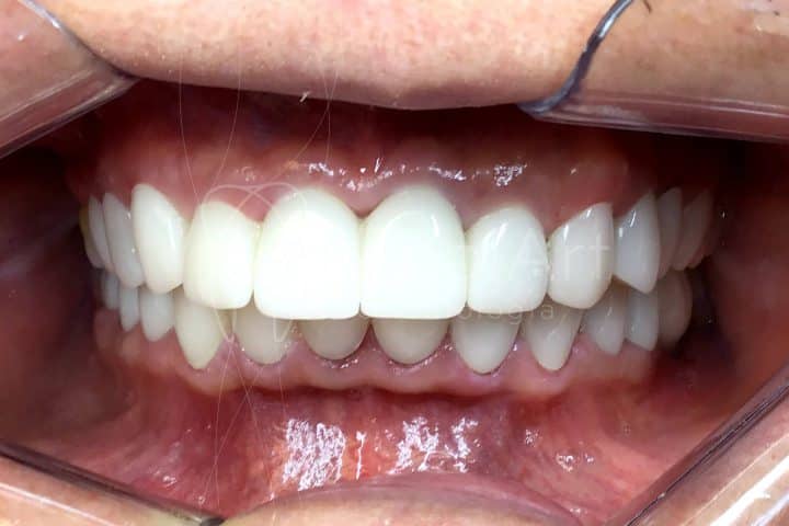 lentes dentais antes e depois na implart