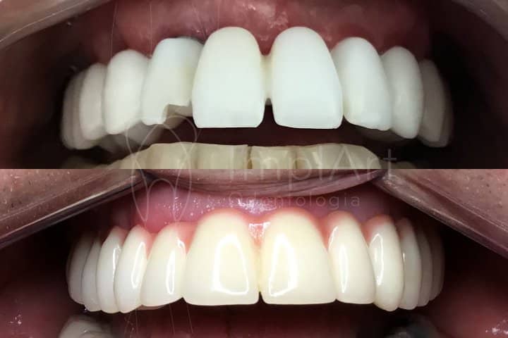 protese fixa em zirconia aplicada