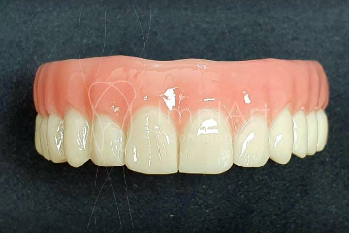 protese dentaria fixa em implante dentario