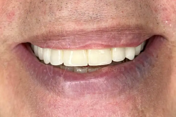 prótese dentária fixa em implantes dentarios